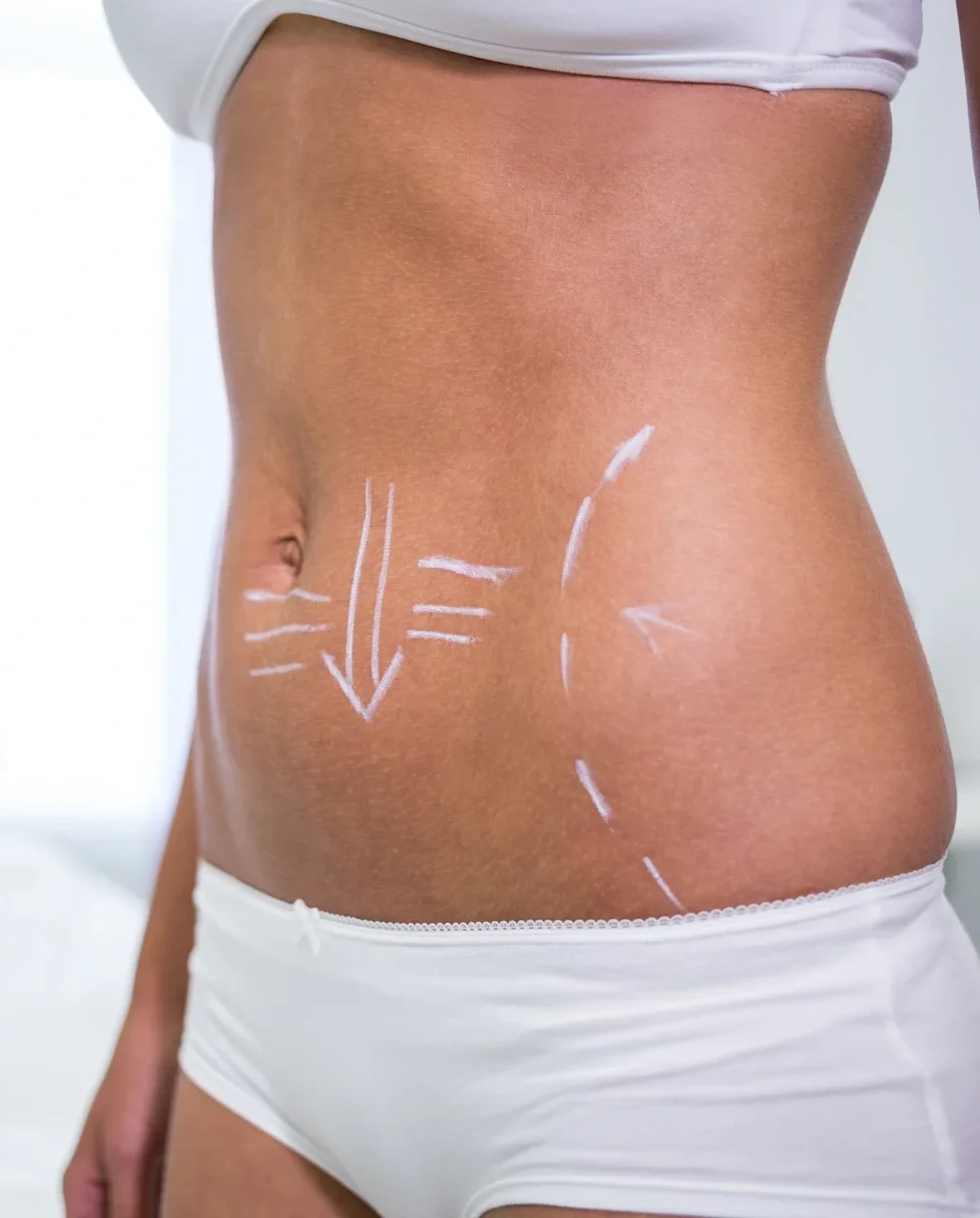 adominoplastia e1773423925425