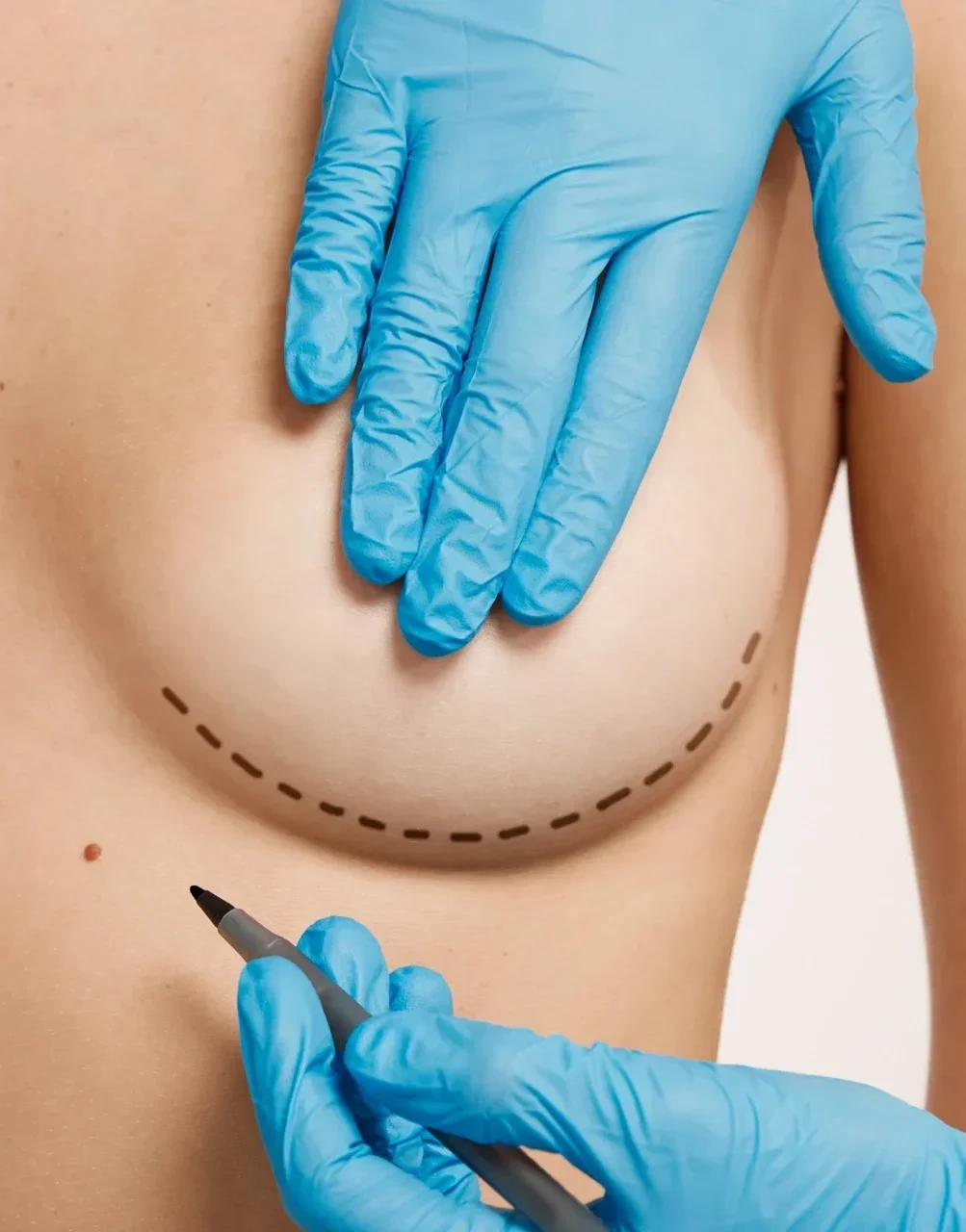 reduccionpecho e1773424120329