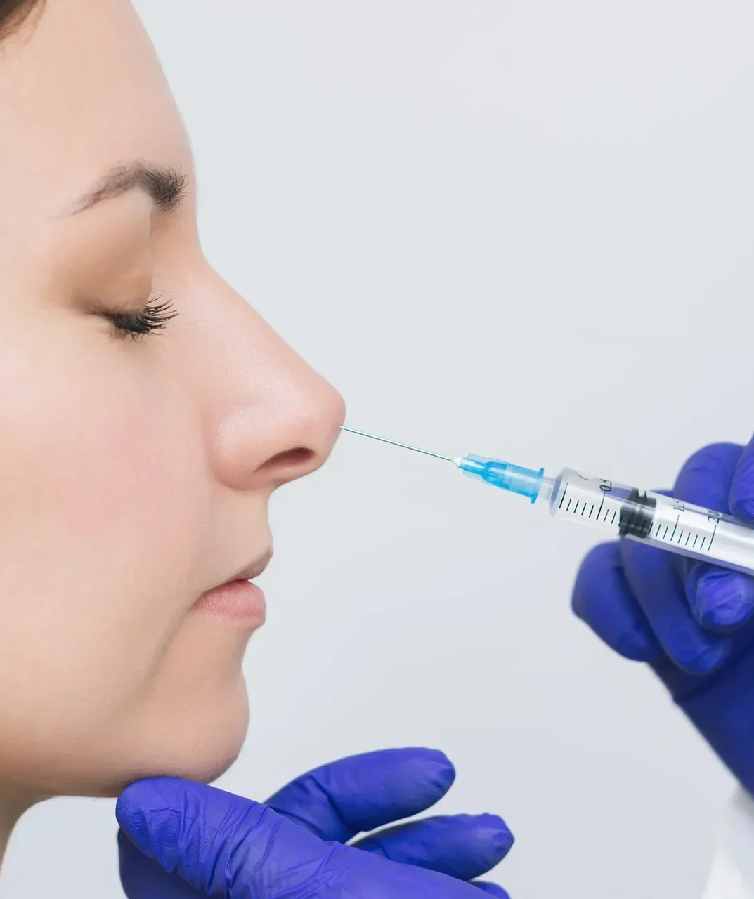 surco nariz e1773429320126