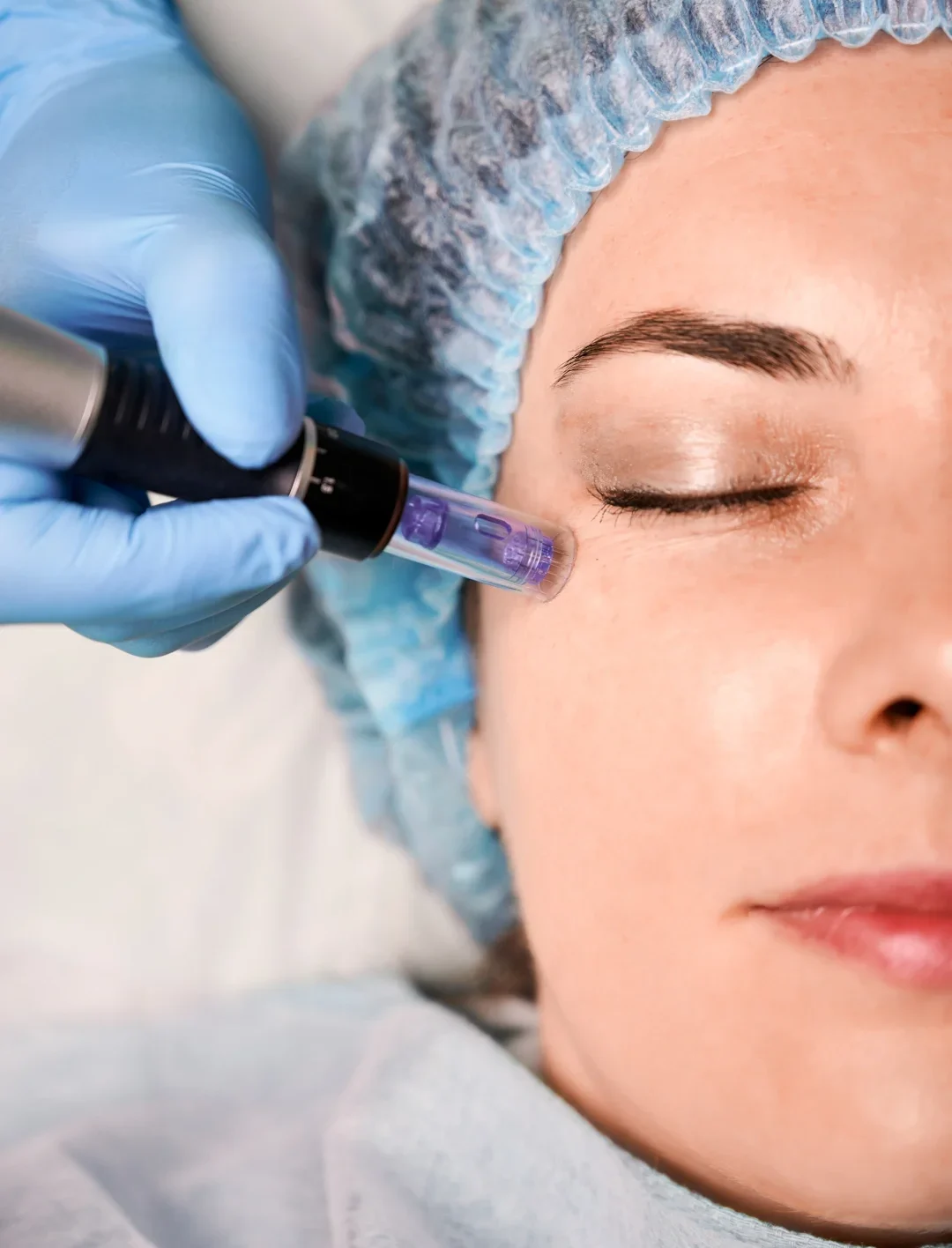 dermapen e1773640876747