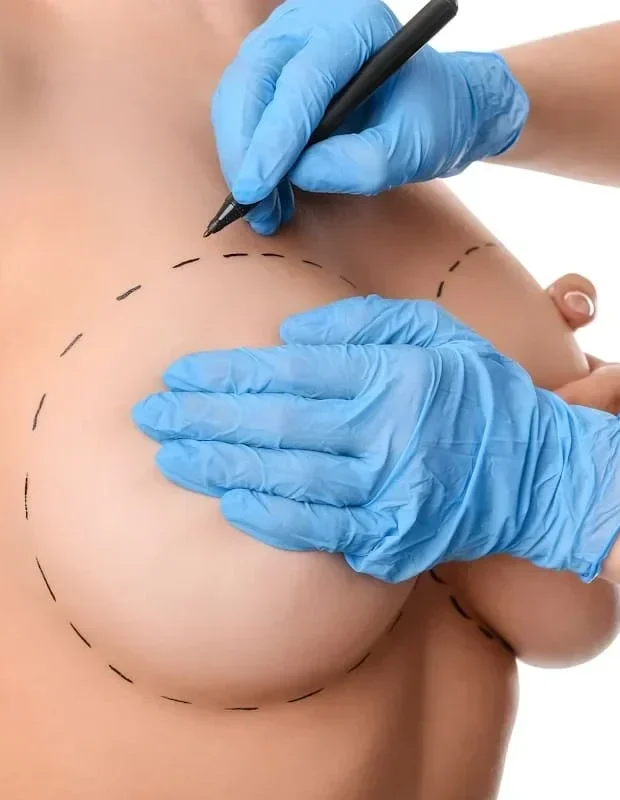 mamoplastia 1 e1773424066773