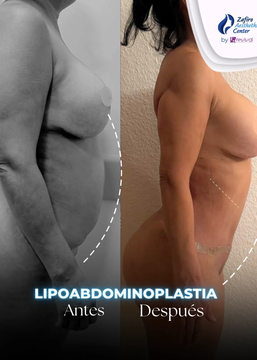 Lipoabdominoplastia 2_2