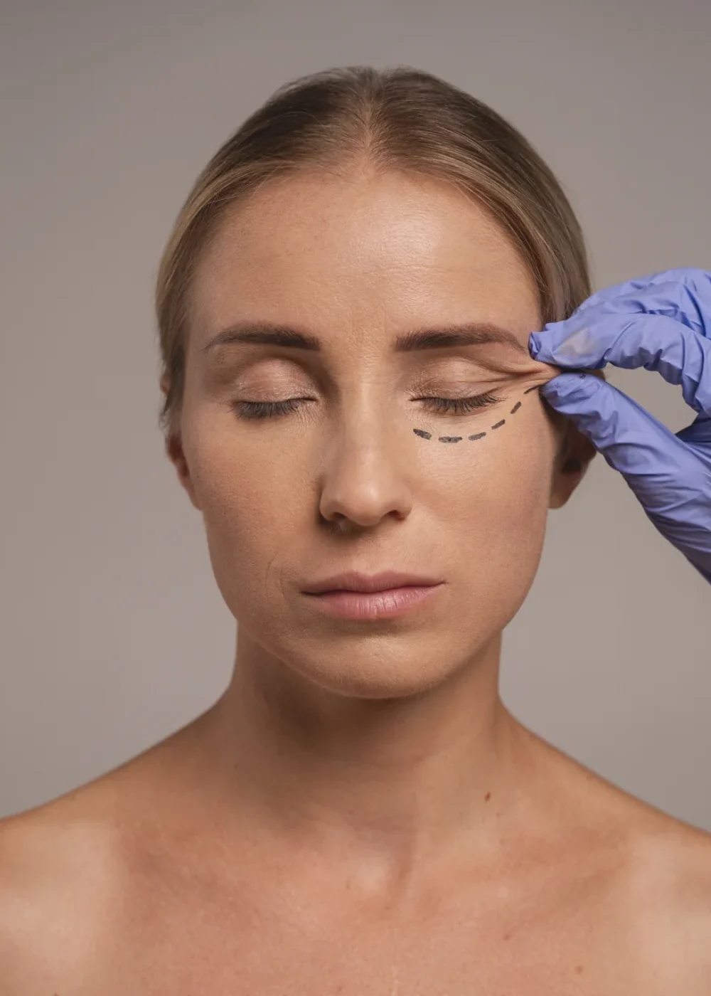blefaroplastia